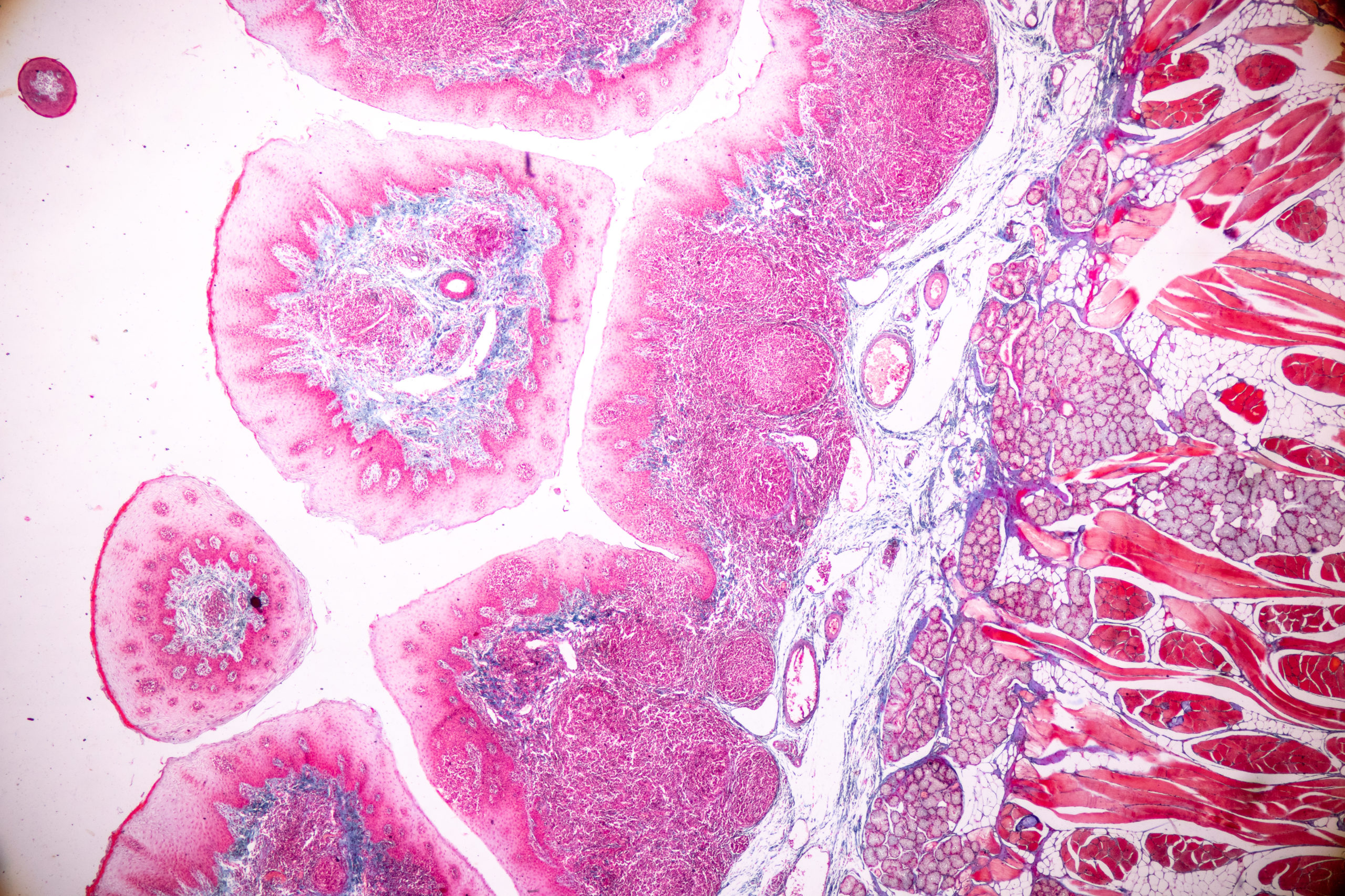 68-Year-Old Man Diagnosed with Malignant Pleural Mesothelioma in Conjunction with Metastatic Malignant Mesothelioma in the Form of a Tongue Lesion