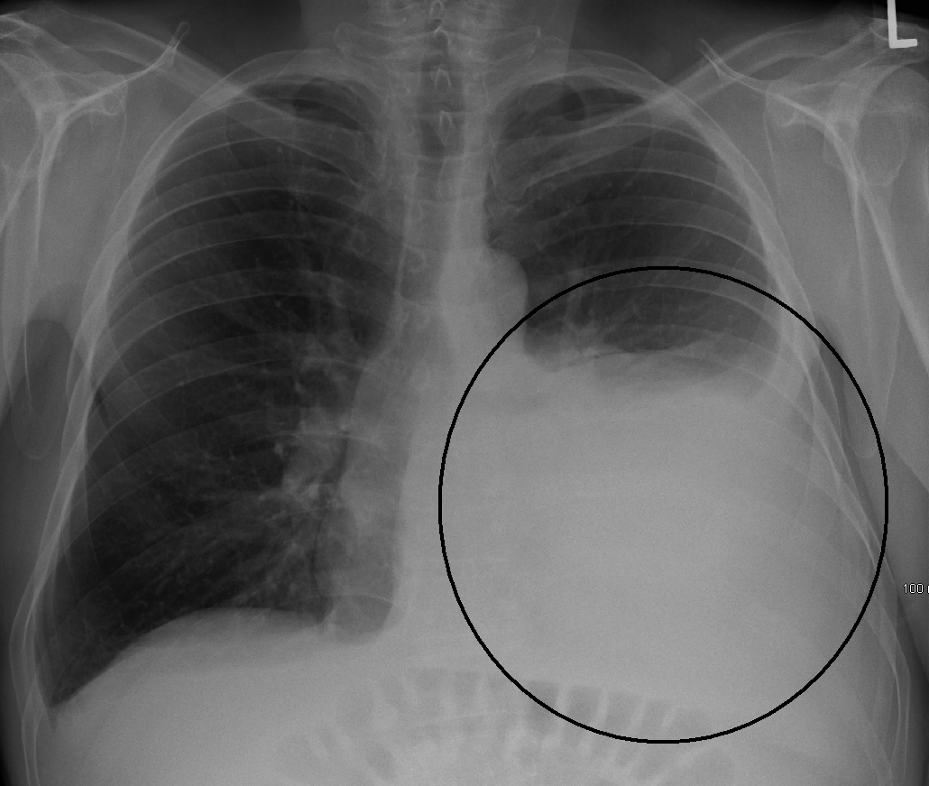 Pleural Effusions & Mesothelioma