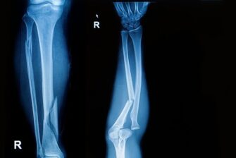 NYC Broken bones and fractures - Belluck _ Fox LLP