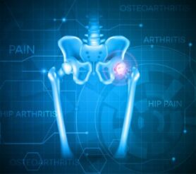 Depuy Hip Lawsuit