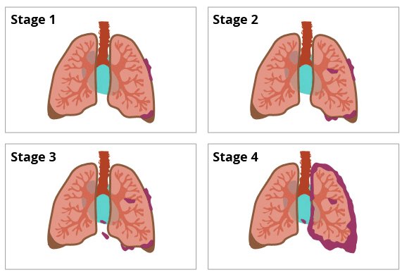 mesothelioma stages of cancer